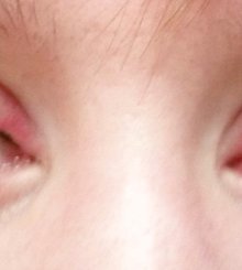 Как выглядят глаза после процедуры