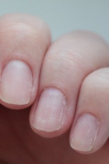 Осложнения от постоянного и неправильного покрытия ногтей гель-лаком